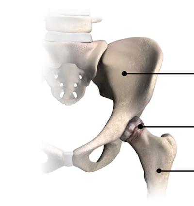 arthritic hip