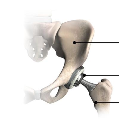 A replaced hip with a hip implant